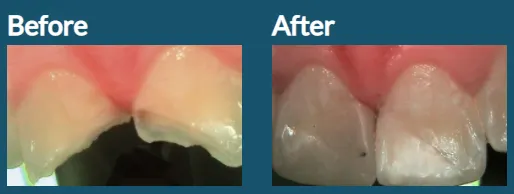 Chipped Teeth 2