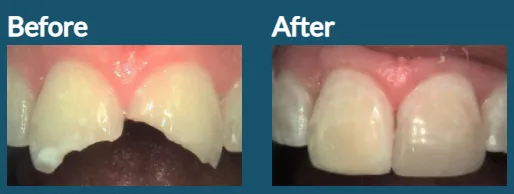 Chipped Teeth