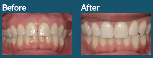 Closing a Gap with Invisalign