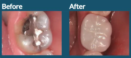 Crown to Fix Broken Tooth