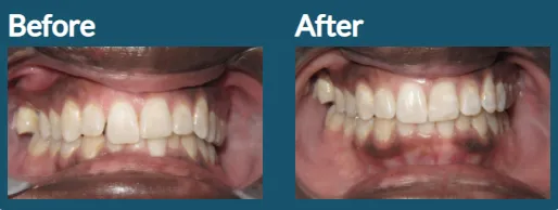Improving Smile with Invisalign