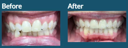 Invisalign for crowded teeth