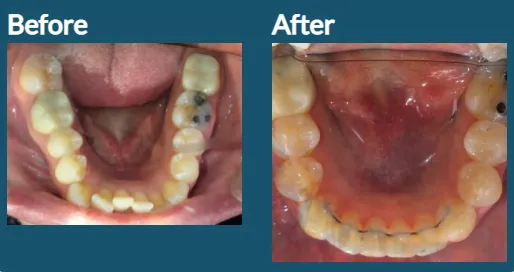 Invisalign for lower crowded teeth