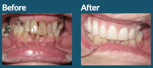 Partial Denture