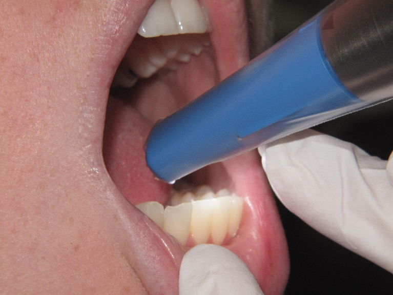 Intraoral-Cameras