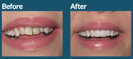 veneers